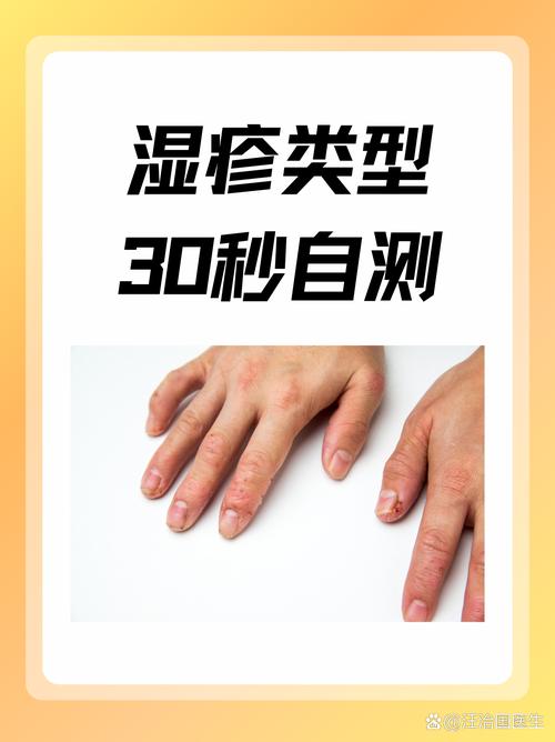 长湿疹是什么症状