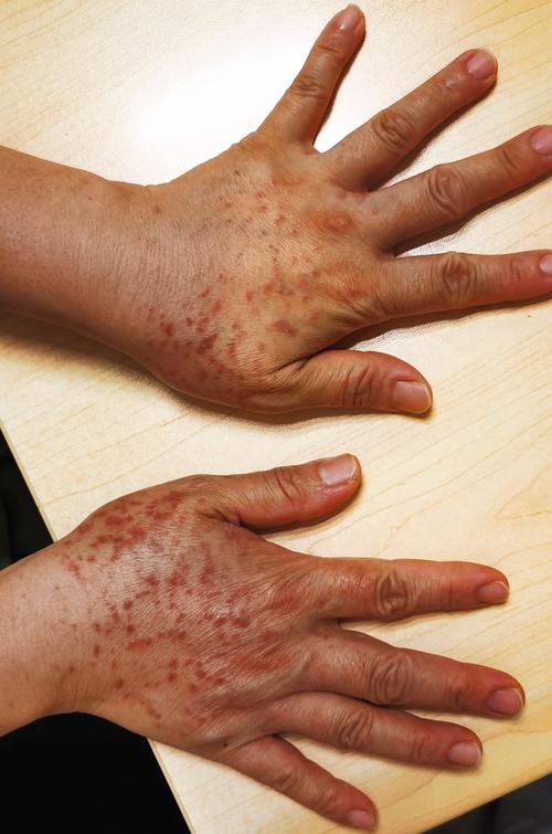 长湿疹是什么症状