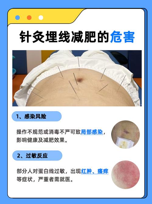 埋线减肥什么原理