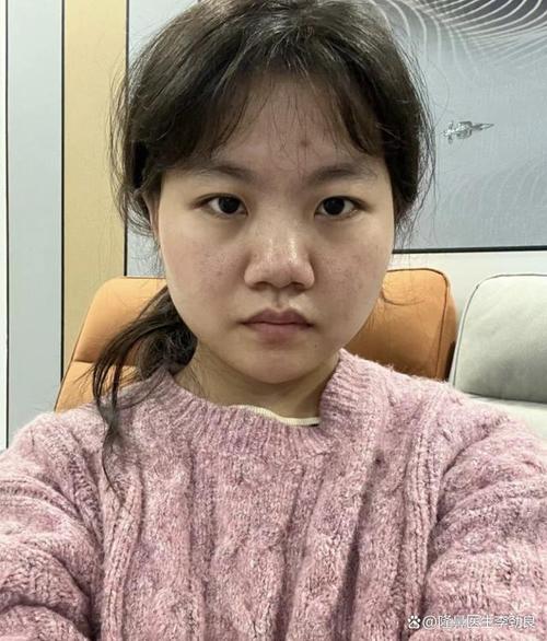 什么是宽鼻