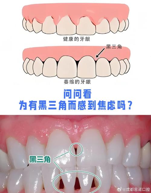 牙齿黑三角是什么