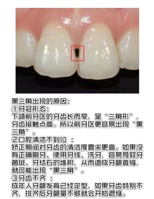 牙齿黑三角是什么