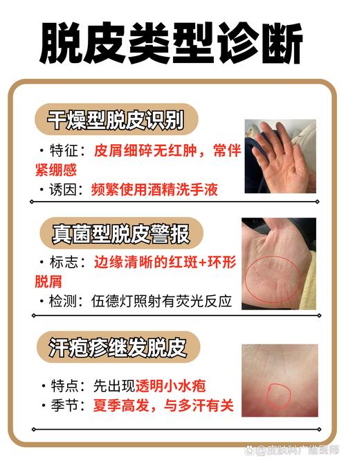 手掌起皮是什么原因