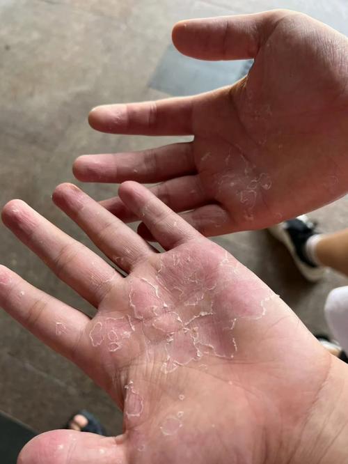 手掌起皮是什么原因