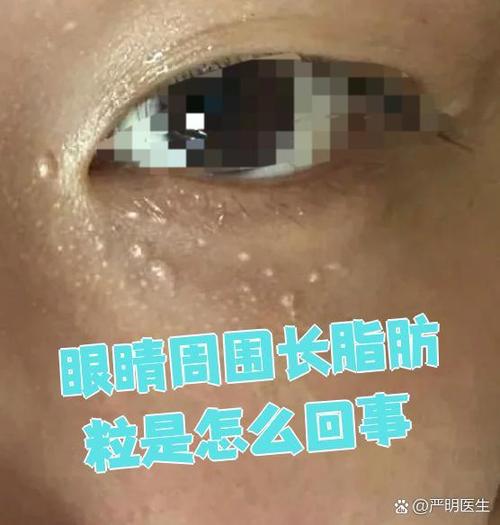 眼睛为什么长脂肪粒