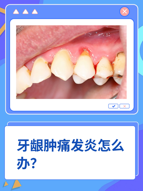 牙龈炎有什么症状