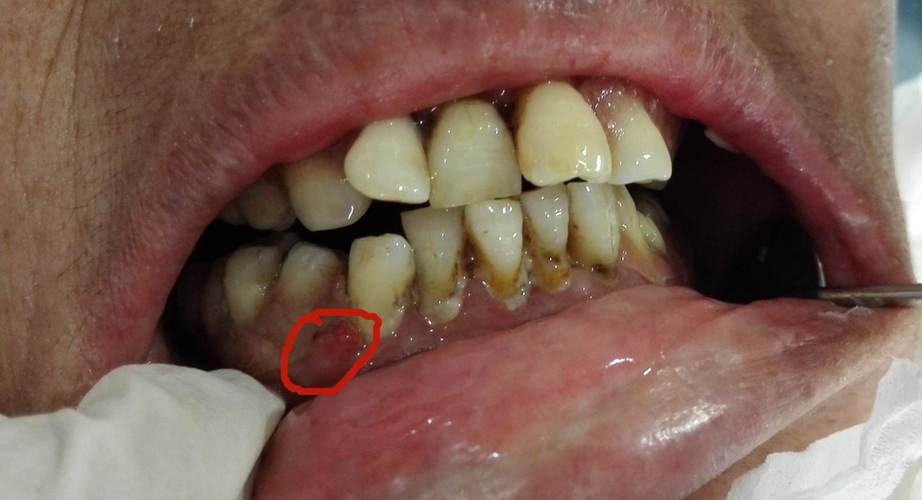 牙龈炎有什么症状