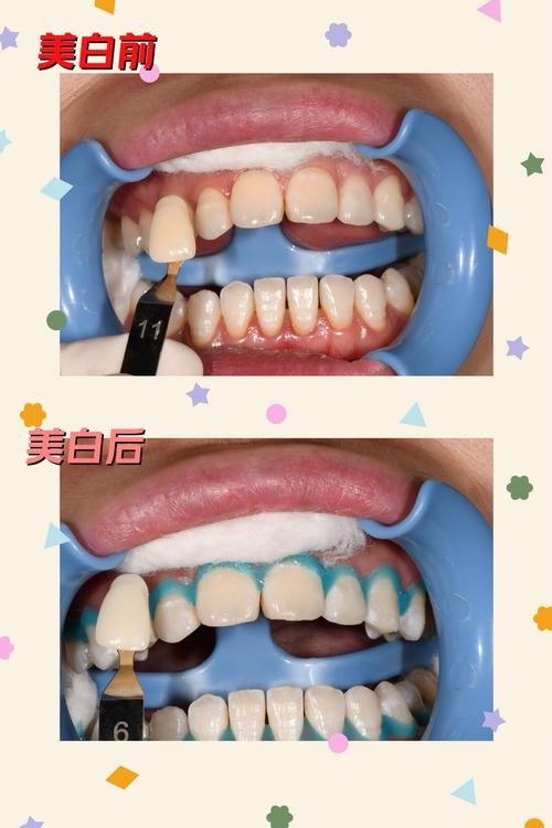 牙齿抛光是什么