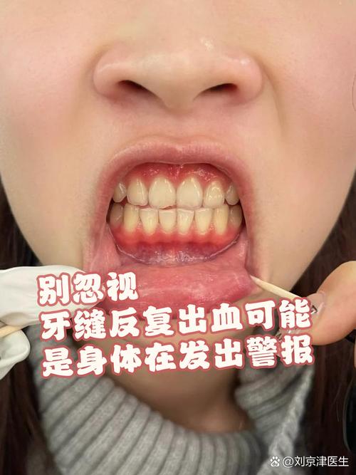 牙缝出血是什么原因