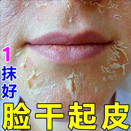 脸上脱皮擦什么好