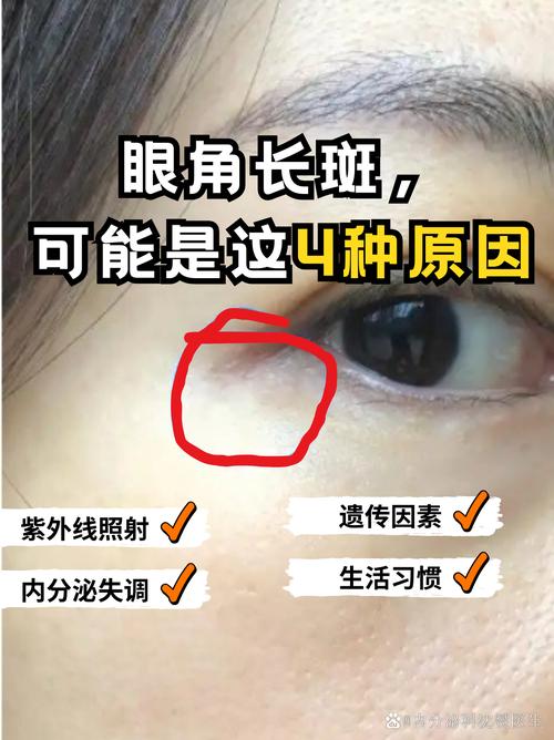 眼角为什么会长斑