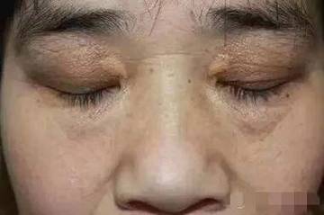 眼角为什么会长斑