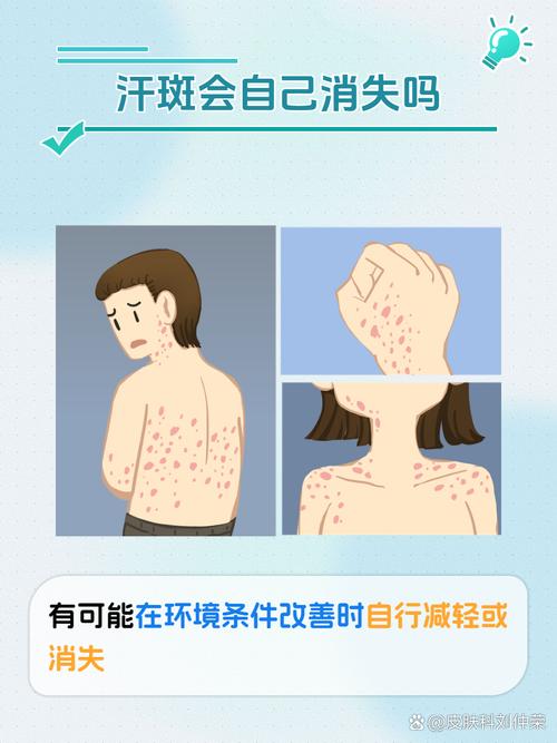 汗斑是什么引起的