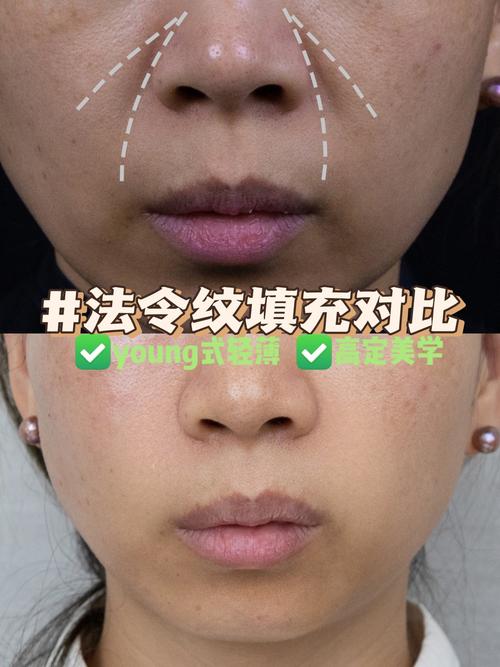 为什么法令纹很深