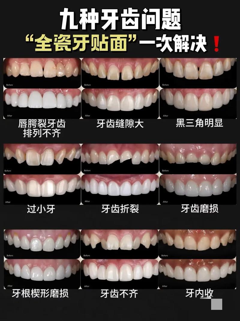 什么是牙齿贴面