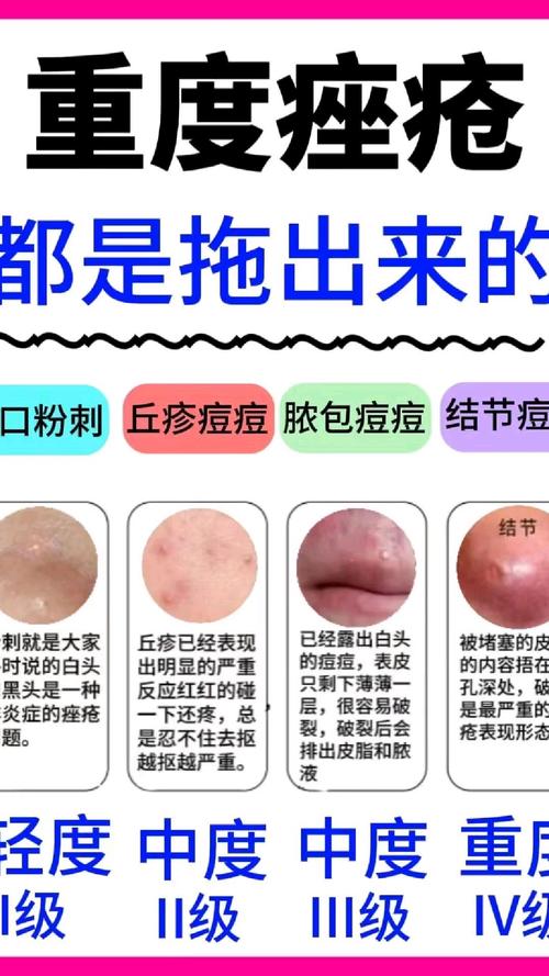 痤疮应该注意什么