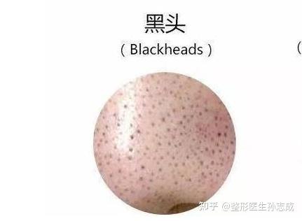 鼻子上的黑点是什么