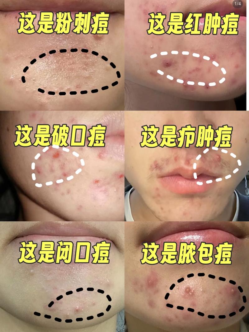 为什么脸上长小痘痘