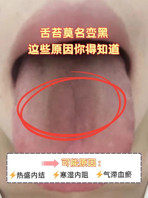 舌头发黑什么情况