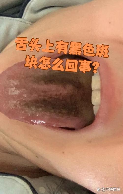 舌头发黑什么情况