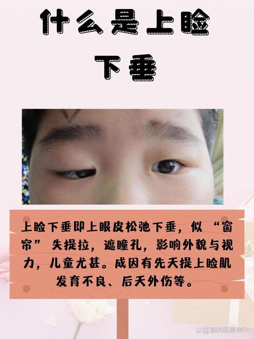 眼皮下垂是什么病