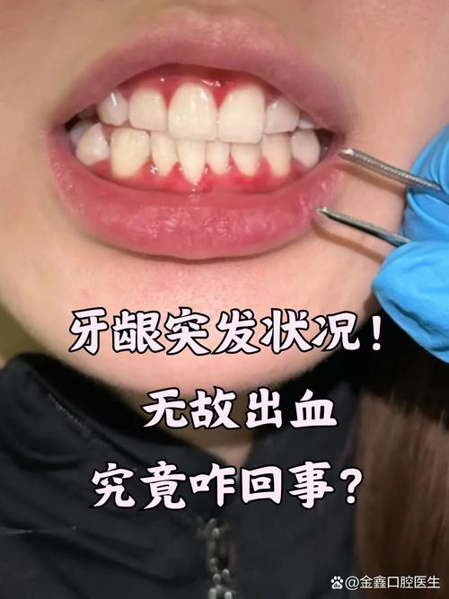 为什么牙龈经常出血