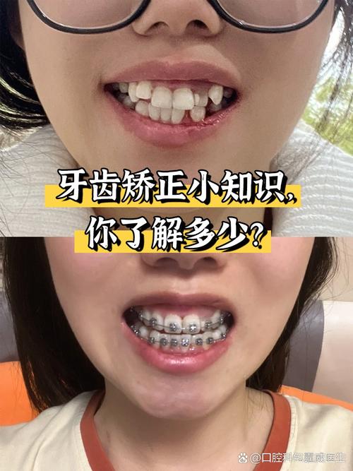 矫正牙齿有什么方法
