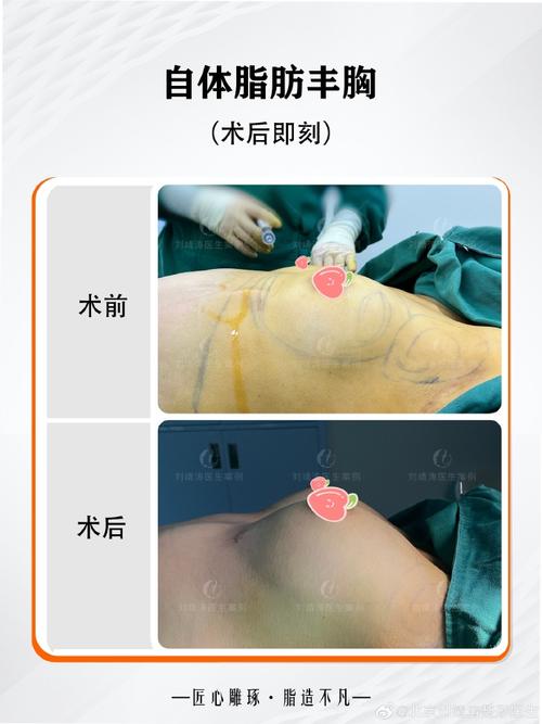 什么是丰胸手术