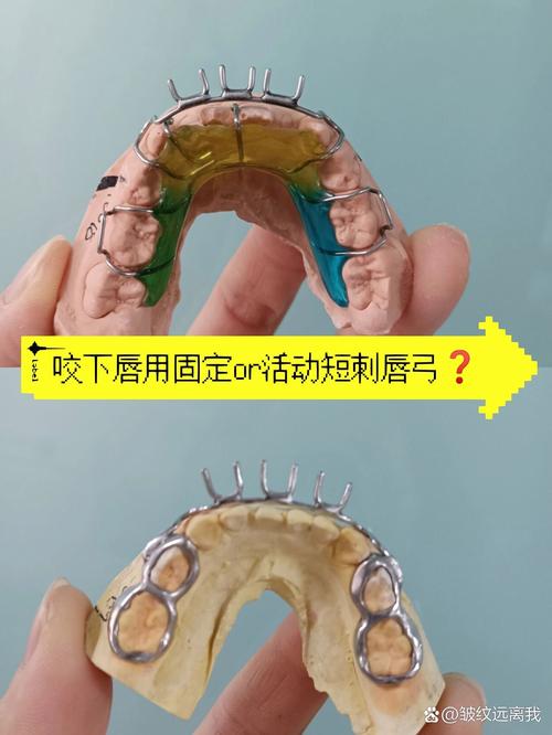 唇弓是什么