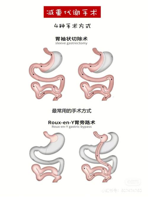 动什么手术可以减肥