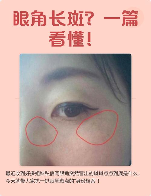 为什么眼角会长斑