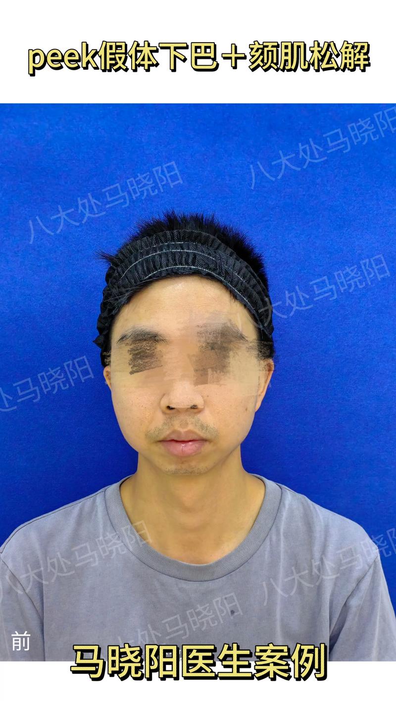 什么是小下巴