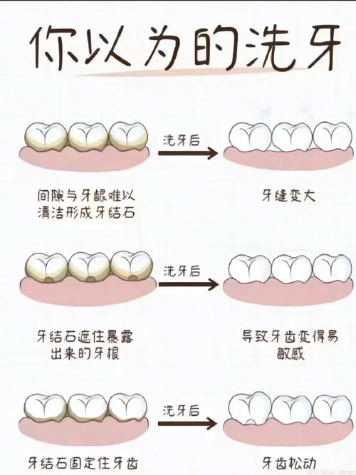 什么情况需要洗牙