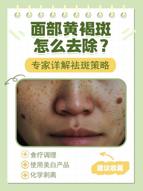 黄褐斑是什么斑