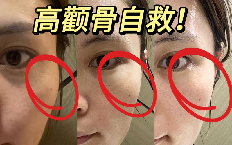颧骨高是什么原因