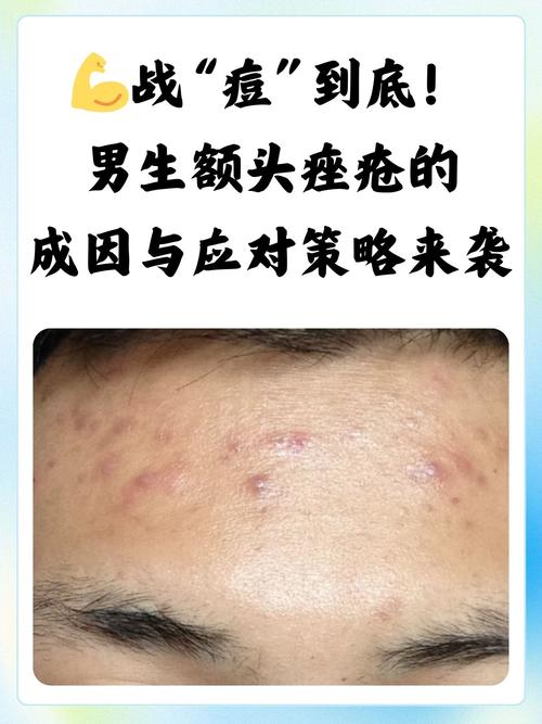 男生为什么会长痘