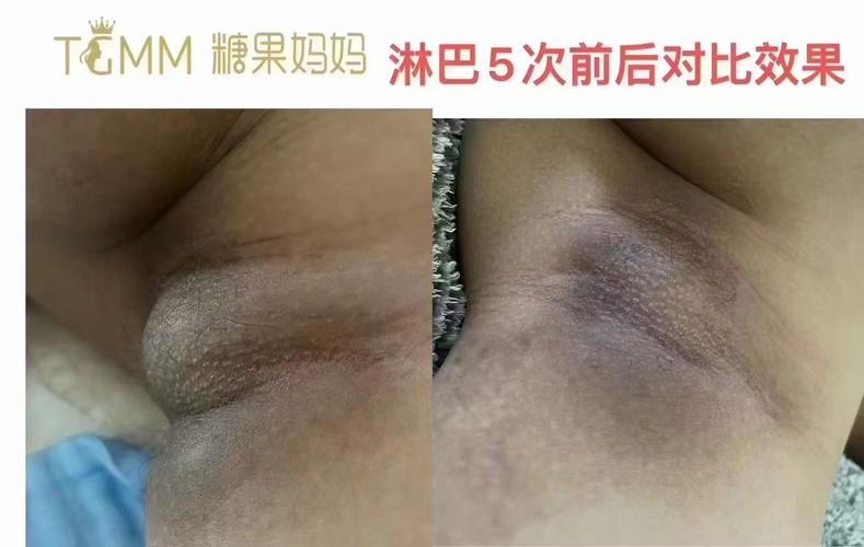 淋巴为什么会堵