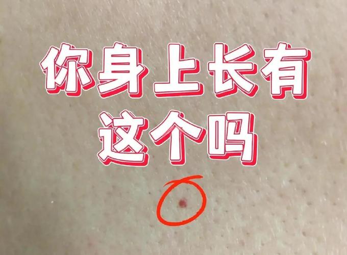 什么是血管痣