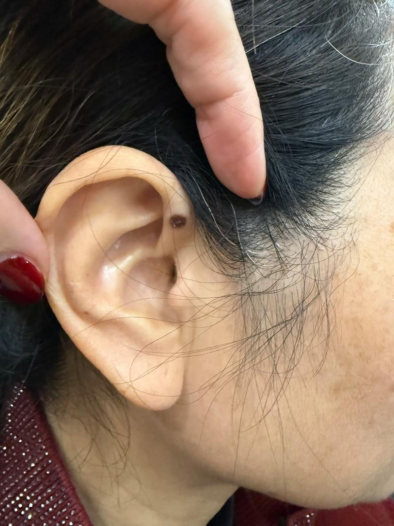 什么是血管痣