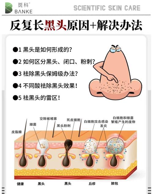 为什么脸上有黑头