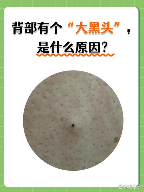 为什么脸上有黑头