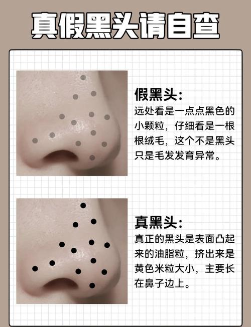 为什么不能挤黑头