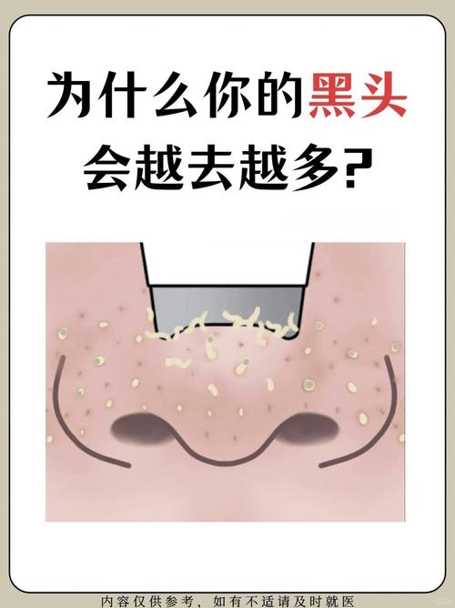 为什么不能挤黑头