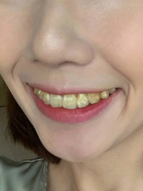 什么是黄牙