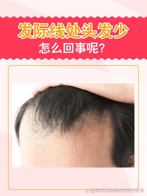 头发变少是什么原因