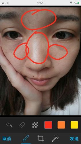 混合性皮肤是什么