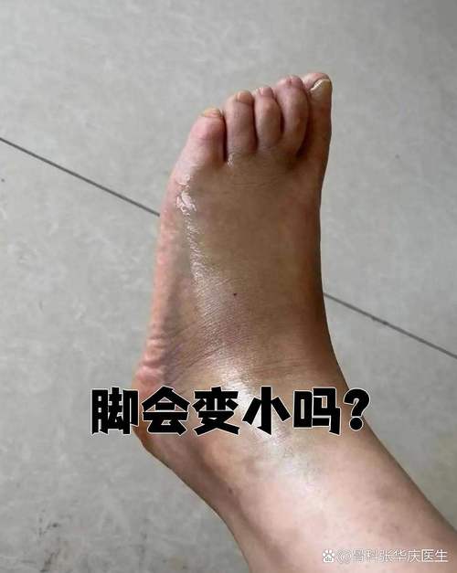 减肥脚为什么会变小