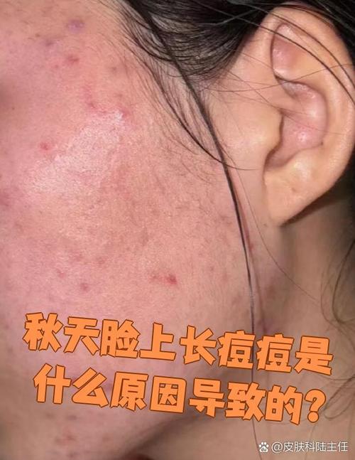 秋天为什么长痘痘