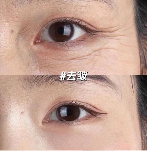 什么除皱纹效果好