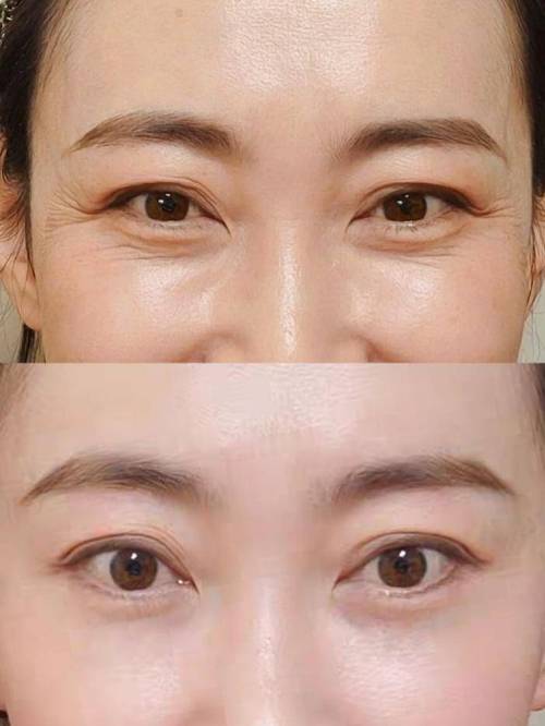 什么除皱纹效果好